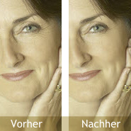 Falten Vorher / Nachher