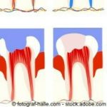 Wenn die Zahnwurzel schmerzt